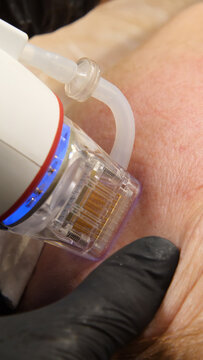A multifunctional device for microneedle RF lifting. Aesthetic procedures for non-surgical lifting, smoothing fine lines, minimizing pores, regulating sebum production, and evening out skin texture.