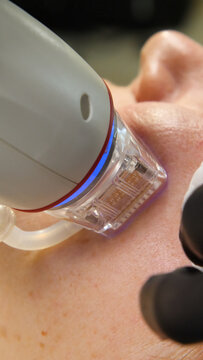 A multifunctional device for microneedle RF lifting. Aesthetic procedures for non-surgical lifting, smoothing fine lines, minimizing pores, regulating sebum production, and evening out skin texture.
