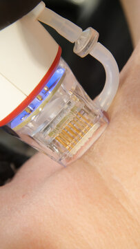 A multifunctional device for microneedle RF lifting. Aesthetic procedures for non-surgical lifting, smoothing fine lines, minimizing pores, regulating sebum production, and evening out skin texture.