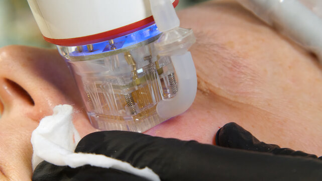 A multifunctional device for microneedle RF lifting. Aesthetic procedures for non-surgical lifting, smoothing fine lines, minimizing pores, regulating sebum production, and evening out skin texture.