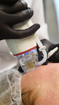 A multifunctional device for microneedle RF lifting. Aesthetic procedures for non-surgical lifting, smoothing fine lines, minimizing pores, regulating sebum production, and evening out skin texture.