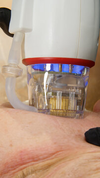 A multifunctional device for microneedle RF lifting. Aesthetic procedures for non-surgical lifting, smoothing fine lines, minimizing pores, regulating sebum production, and evening out skin texture.
