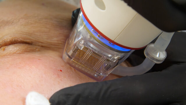 A multifunctional device for microneedle RF lifting. Aesthetic procedures for non-surgical lifting, smoothing fine lines, minimizing pores, regulating sebum production, and evening out skin texture.