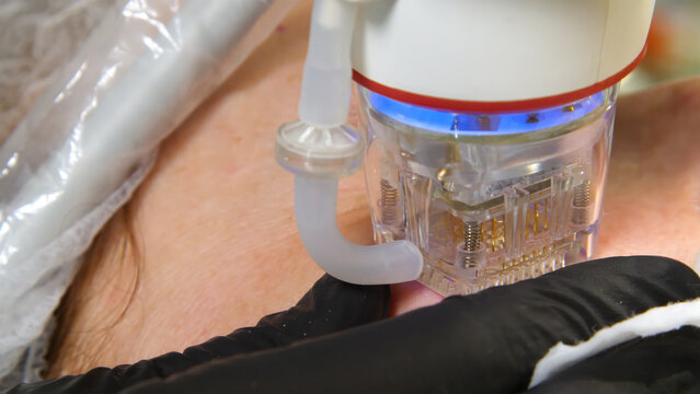 A multifunctional device for microneedle RF lifting. Aesthetic procedures for non-surgical lifting, smoothing fine lines, minimizing pores, regulating sebum production, and evening out skin texture.