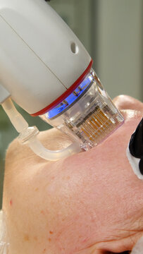 A multifunctional device for microneedle RF lifting. Aesthetic procedures for non-surgical lifting, smoothing fine lines, minimizing pores, regulating sebum production, and evening out skin texture.