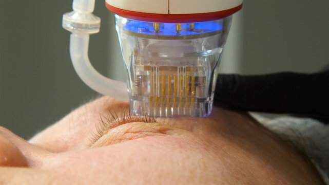 A multifunctional device for microneedle RF lifting. Aesthetic procedures for non-surgical lifting, smoothing fine lines, minimizing pores, regulating sebum production, and evening out skin texture.