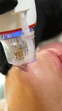 A multifunctional device for microneedle RF lifting. Aesthetic procedures for non-surgical lifting, smoothing fine lines, minimizing pores, regulating sebum production, and evening out skin texture.