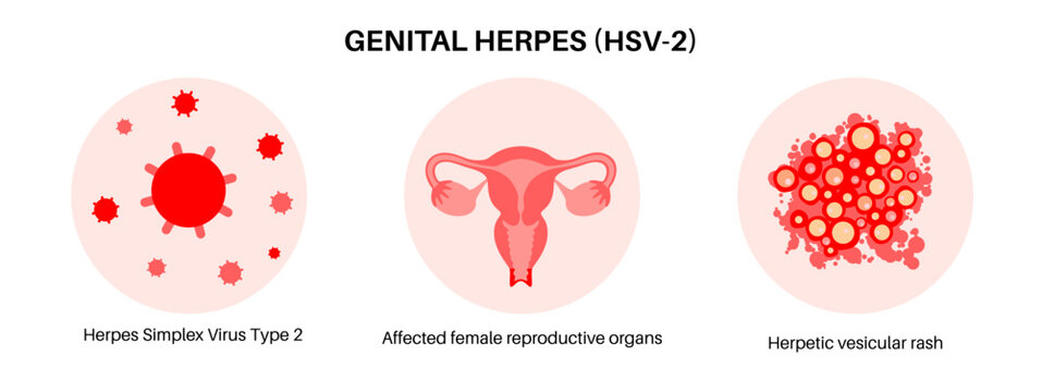 Vesicular rash infographic layout