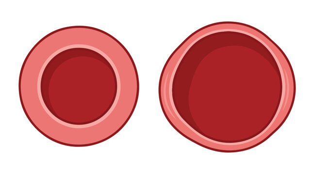 Red blood cell vector illustration, normal erythrocyte and macrocytic cell comparison, medical education diagram