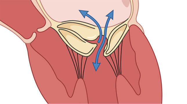 Mitral valve regurgitation medical vector illustration, heart valve defect diagram, abnormal blood backflow pathology graphic
