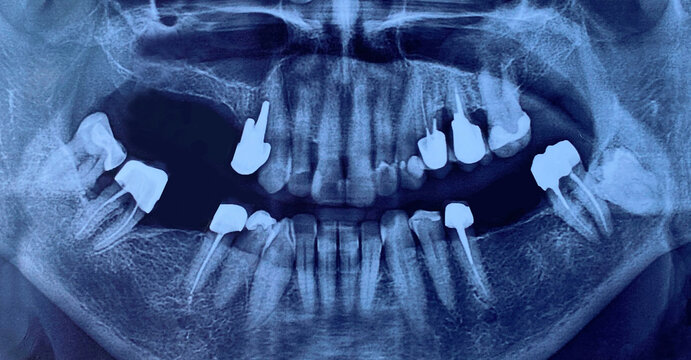 Close-up of image panoramic x-ray of teeth and jaw human