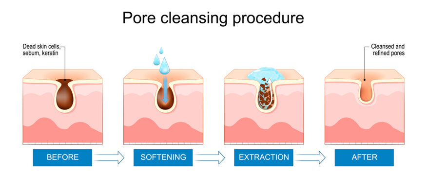 Pore cleansing procedure. Skin with clogged pore before and after treatment. Comedone removal