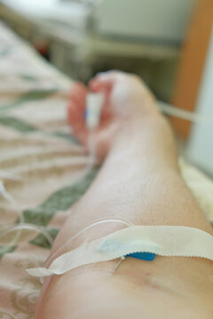 Close-up of a peripheral intravenous catheter inserted into a patient's arm, secured with medical tape and connected to tubing for hospital treatment, infusion therapy or hydration