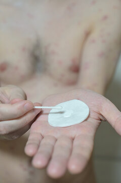Treatment of ulcers from Chickenpox varicella zoster virus rash with medical cream using a cotton swab and pad on the adult man skin. Skin disease. Dermatology