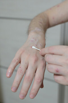 Treatment of ulcers from Chickenpox varicella zoster virus rash with medical cream using a cotton swab on the adult man skin. Skin disease. Dermatology