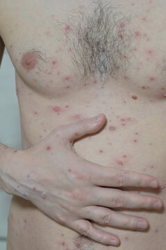 Chickenpox varicella zoster virus rash. Vesicles papules, ulcers, crusts at different stages on the skin of an adult male torso. Skin disease. Dermatology. Treatment