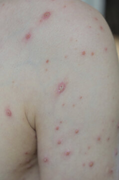 Chickenpox varicella zoster virus rash. Vesicles papules, ulcers, crusts on the skin of an adult male shoulder. Skin disease. Dermatology. Treatment