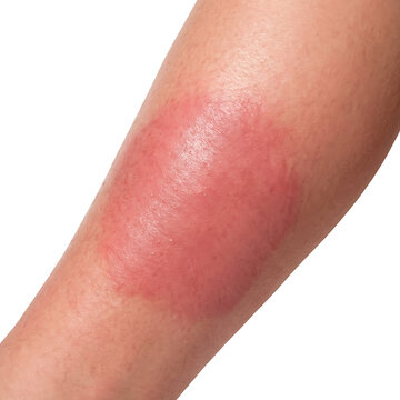 Close-up of Red Skin Rash and Inflammation on Human Leg Isolated on White Background