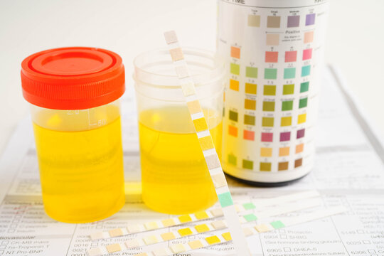 Urinalysis, urine cup for check health examination in laboratory.