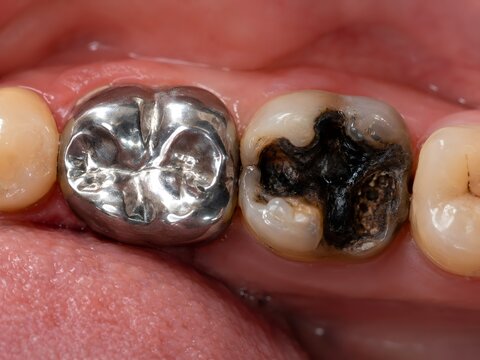 Silver Crown Beside Decayed Tooth, Dental Damage Close-Up Detail, Open Mouth Oral Health Scene, Metal Restoration and Rot Focus, Clinical Dentistry Observation  