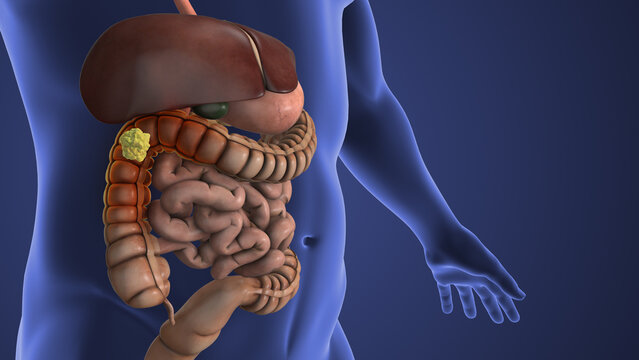 Colon Polyp Developing Inside the Large Intestine