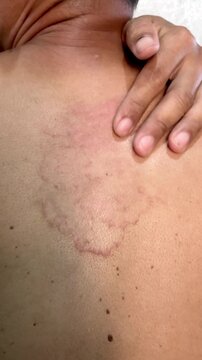 Slow motion vertical close up of a hand scratching a large, red, itchy ringworm rash on a person's back. The skin shows a severe fungal infection, allergy, or dermatitis causing discomfort.