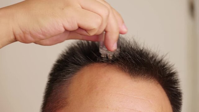 Man massages his hair with hair growth serum.