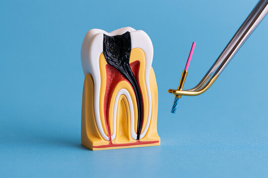 A dental model of a decayed tooth with an endodontic file held by tweezers. This visual represents a root canal procedure for professional dental education.
