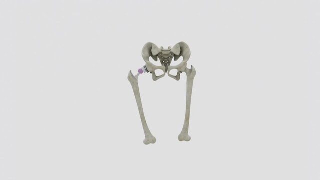 Total hip replacement is a surgical procedure that replaces damaged or diseased parts of the hip joint with artificial components to restore joint function and mobility in 4K Video UHD