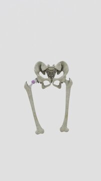 Total hip replacement is a surgical procedure that replaces damaged or diseased parts of the hip joint with artificial components to restore joint function and mobility in Vertical Video UHD