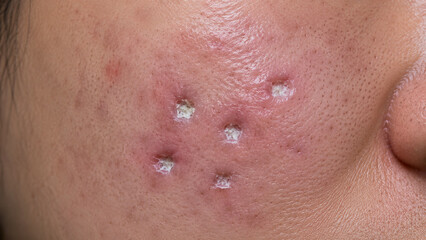 Naklejka premium Close-up of inflamed skin with multiple pustules and acne lesions on human cheek