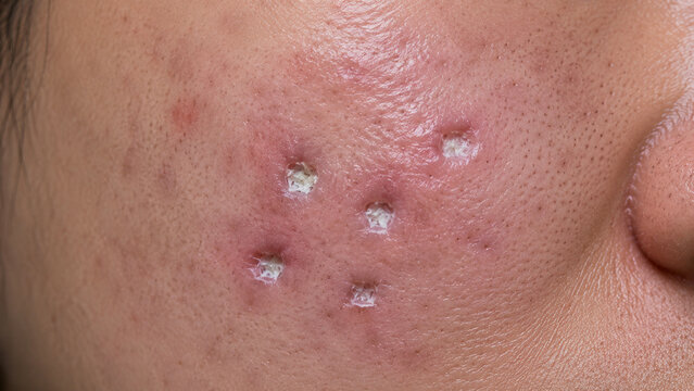 Close-up of inflamed skin with multiple pustules and acne lesions on human cheek