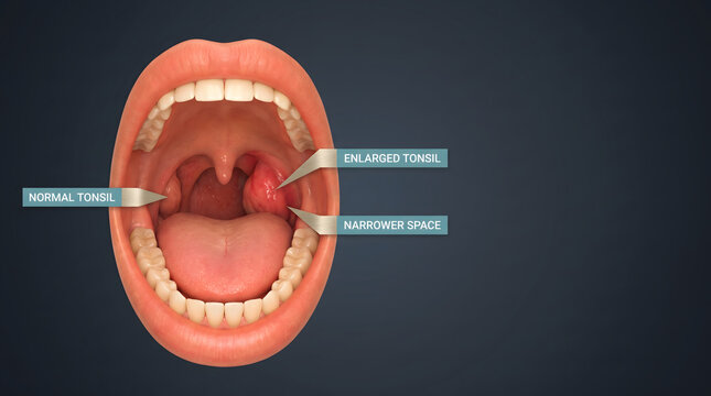 Medical illustration of enlarged tonsils and narrowed airway in human throat. Hypertrophic tonsils and adenoid tissue causing obstruction. Vector diagram for ENT education