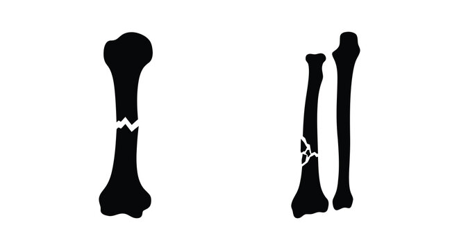 Black silhouettes of fractured femur bones depict medical injury and skeletal damage