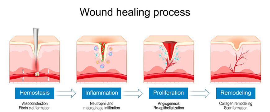 Wound healing process. Hemostasis, Inflammation, Proliferation and Remodeling skin epithelium. Stages of tissue repair and skin regeneration