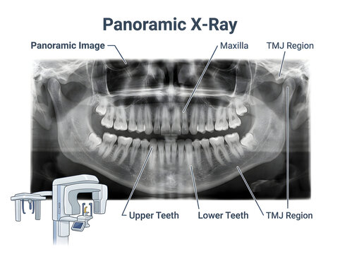 Panoramic dental x-ray showing teeth and jaw structure isolated on white background