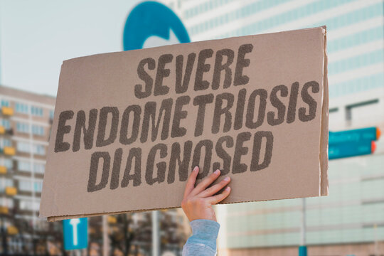 "Severe endometriosis diagnosed" Severe endometriosis diagnosed via surgery. ENDOMETRIOSIS. STAGE. SEVERE. SURGERY. DIAGNOSIS.