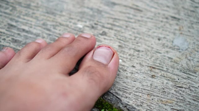 Close-up of a foot with a minor cut on the big toe nail showing redness and small bleeding. Natural skin tone, textured concrete background. Focus on injury detail for medical or health-related.