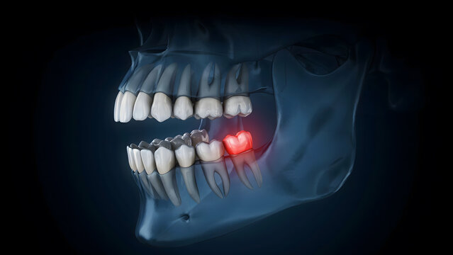 Medical illustration of a human jaw with an inflamed and painful tooth