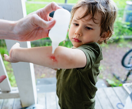 A concerned mother carefully applies healing gel to her scared sons raw, scabbed arm while treating the injury outdoors in the garden.
