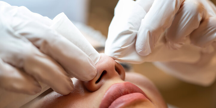 Extreme close up of cosmetologist hands extracting blackheads from woman nose