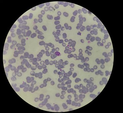 Plasmodium sp. gametocyte stage in human blood smear, malaria parasite microscopic 