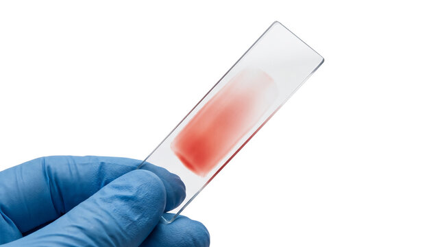 Medical blood smear on glass microscope slide, gloved hand holding laboratory sample, clinical hematology testing on white background