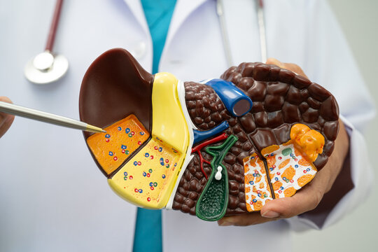 Cirrhosis, Liver cancer, fatty liver, Asian doctor with liver human model.