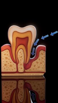 Conceptual 3D motion design animation of periodontitis and gum inflammation