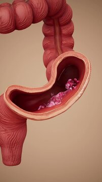 Conceptual 3D animation of colon cancer and tumor growth