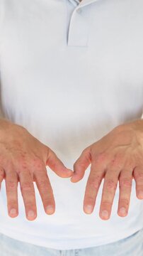 Adult man hands displayed during close skin assessment, showing scattered redness and small lesions. Medical imagery focuses on possible viral rash, Coxsackie infection and dermatology evaluation.