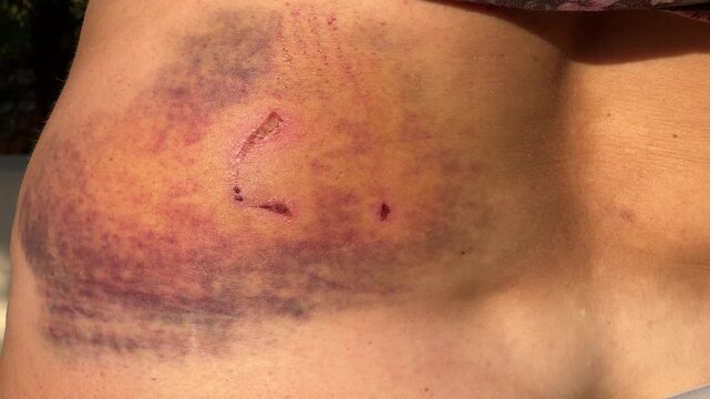 Animal attack dog bite wound and healing bruise video footage