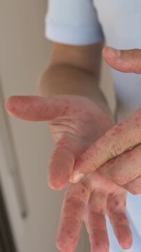 Adult fingers inspected closely for reddish skin lesions and irritation. Coxsackievirus symptoms, viral rash assessment, infectious disease screening and clinical dermatology. Hand-foot-mouth disease