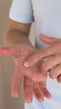 Adult man palm being examined with fingers pointing toward visible red lesions and irritation. Clinical skin assessment, viral rash, Coxsackievirus symptoms and dermatology care concept.